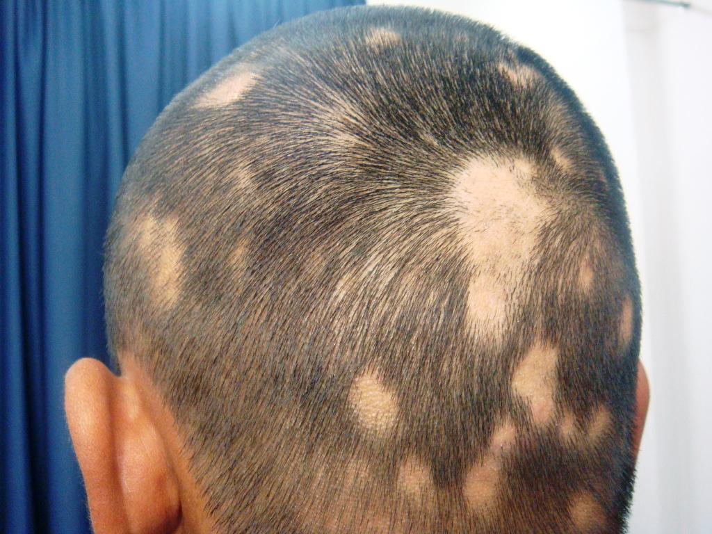 alopecia_areata