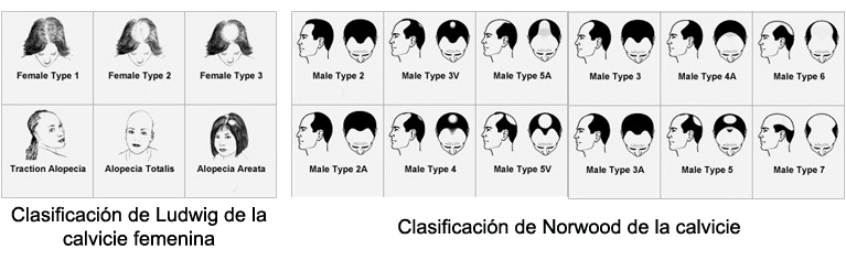 alopecia_clasificacion