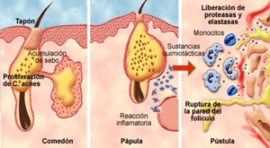 bacterias y acné