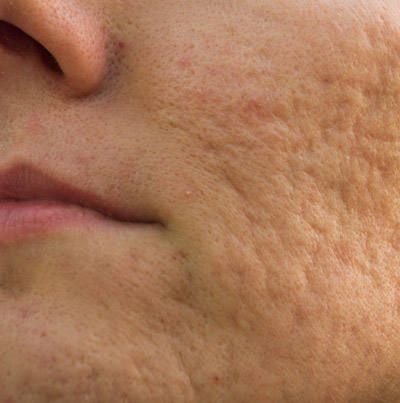 eliminar cicatrices de acne
