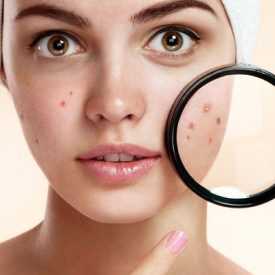 eliminar-acne
