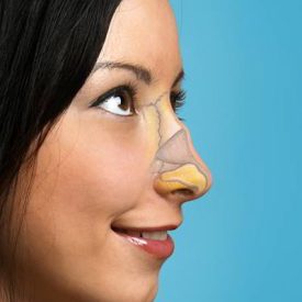 rinoplastia