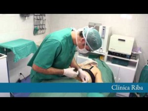 Liposucción_sin_cirugía