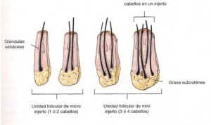 microinjerto capilar